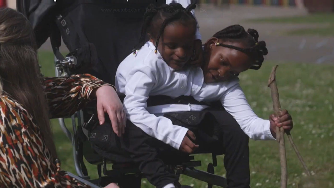 Science-explains-what-occurs-when-one-conjoined-twin-passes-away