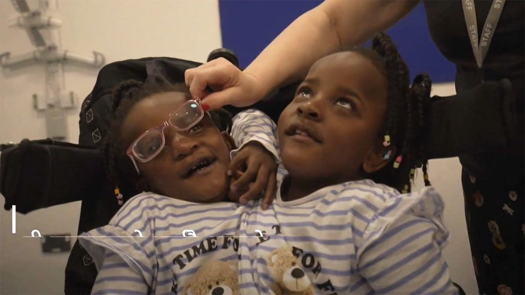 Understanding Conjoined Twins