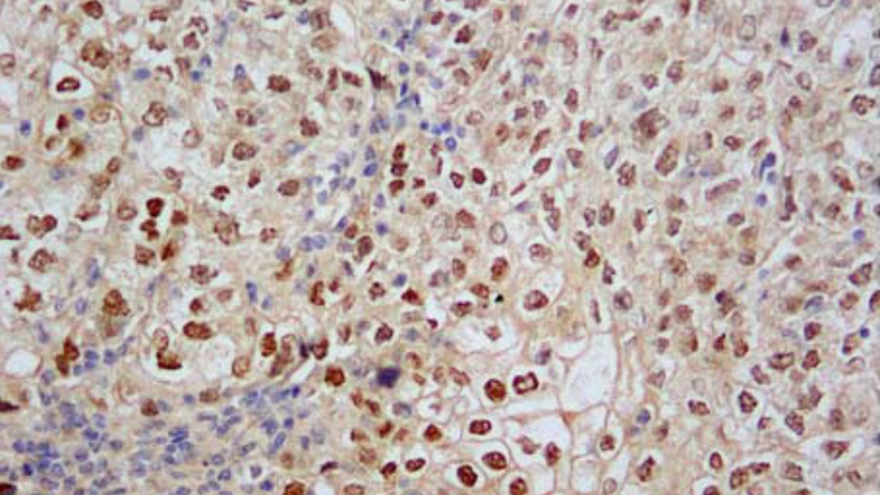 Image Credit: Rajmohan Murali, M.B.B.S., M.D., F.R.C.P.A., Ben Davidson, M.D., Ph.D., Oluwole Fadare, M.D., Joseph A. Carlson, M.D., Ph.D., Christopher P. Crum, M.D., C. Blake Gilks, M.D., Julie A. Irving, M.D., F.R.C.P.C., Anais Malpica, M.D., Xavier Matias-Guiu, M.D., Ph.D., W. Glenn McCluggage, F.R.C.Path., Khush Mittal, M.D., Esther Oliva, M.D., Vinita Parkash, M.D., Joanne K. L. Rutgers, M.D., Paul N. Staats, M.D., Colin J. R. Stewart, M.D., Carmen Tornos, M.D., and Robert A. Soslow, M.D. - CC BY 4.0/Wiki Commons