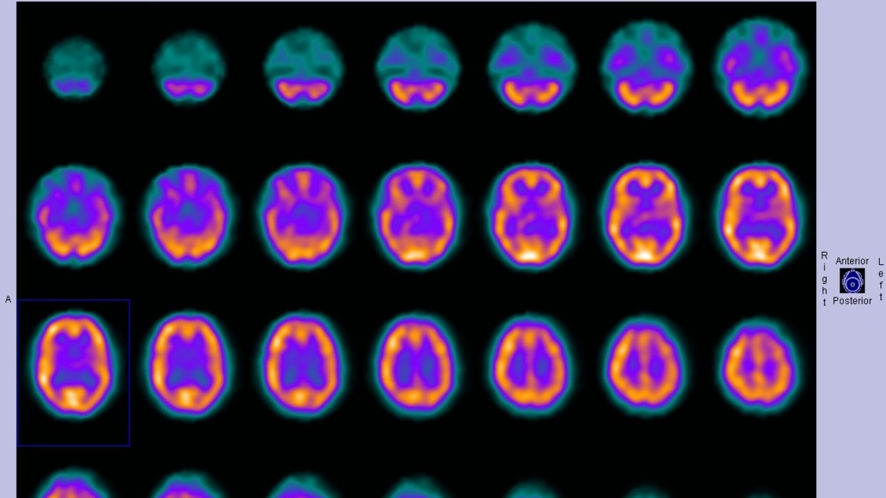 Psilocybin may break depression loops by reshaping brain wiring