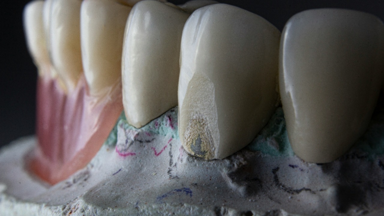 New gel restores lost tooth enamel in two weeks
