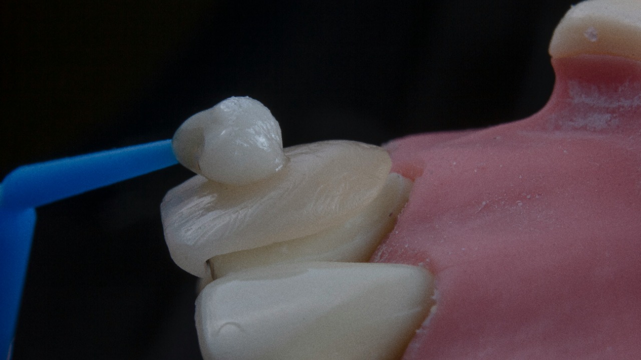 New protein gel regrows enamel and could upend dentistry