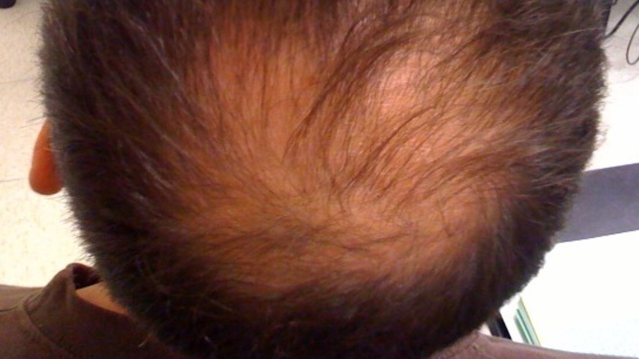 New treatment regrows up to 90% of lost hair