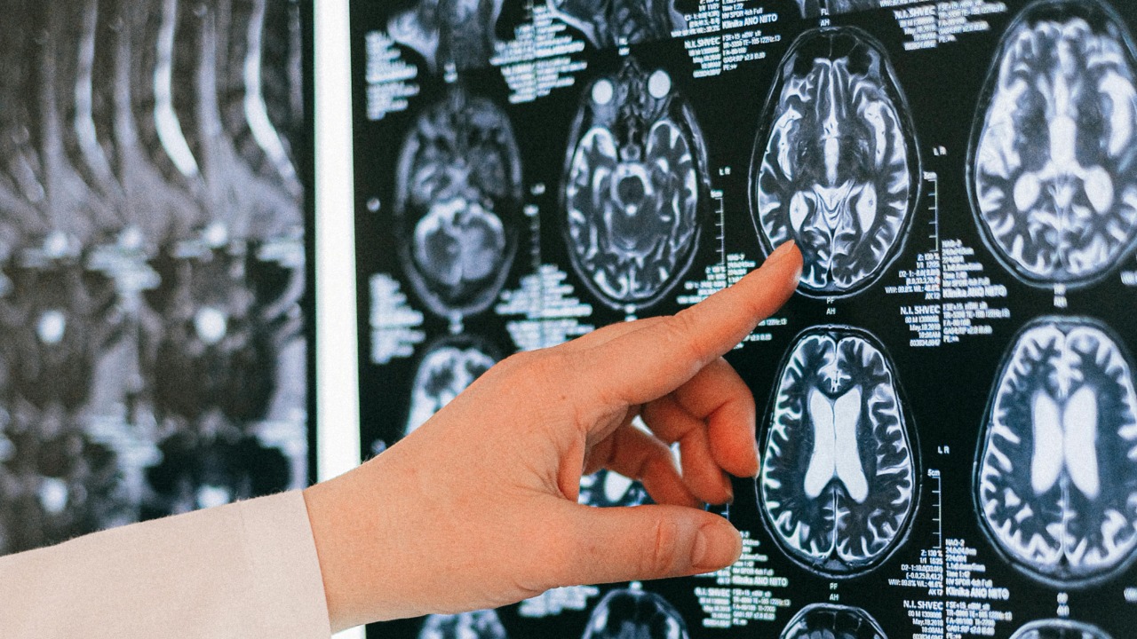 PTSD is linked to accelerated brain aging