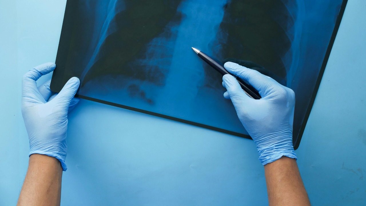 New AI reads routine chest X-rays for early aging clues