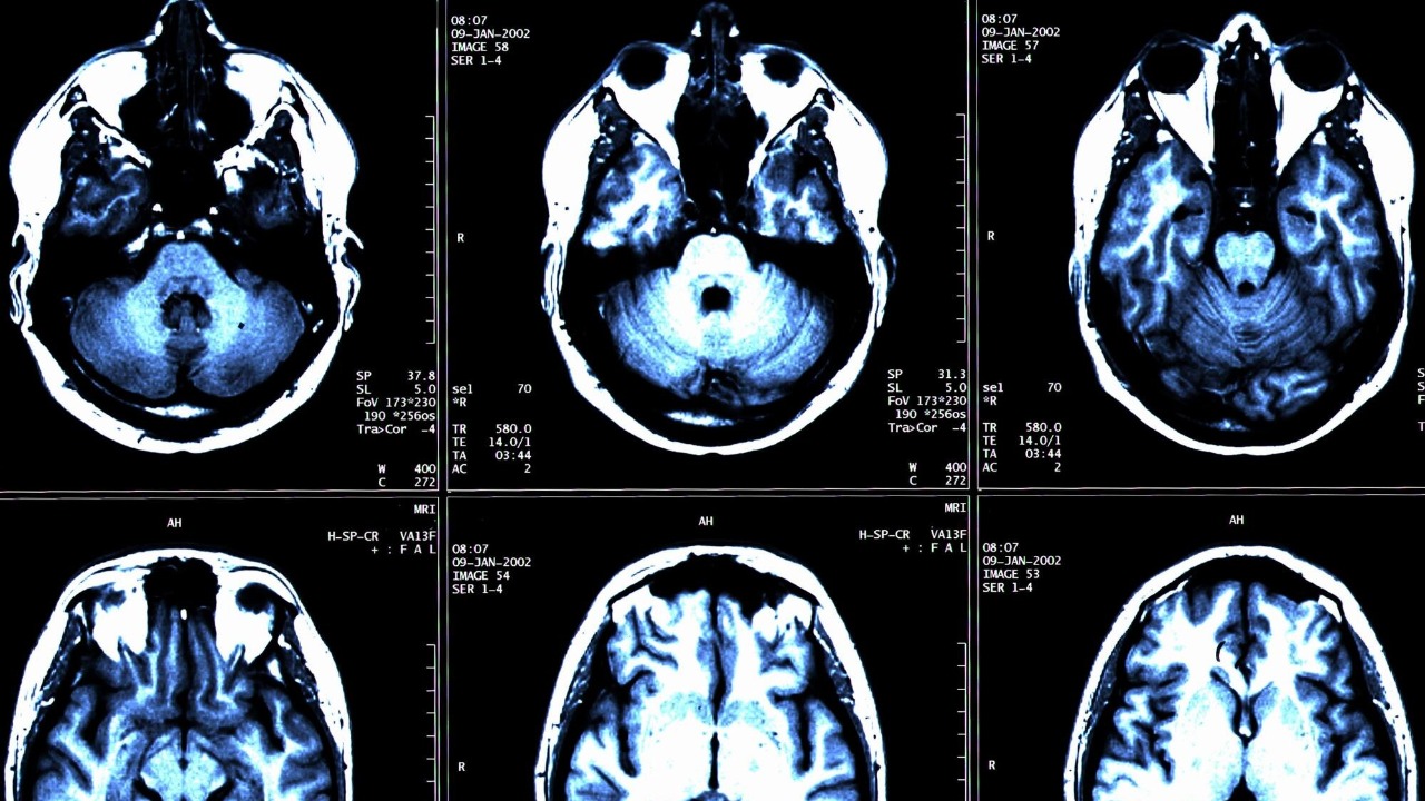 Astronauts’ brains warp in shape after spaceflight, study reveals
