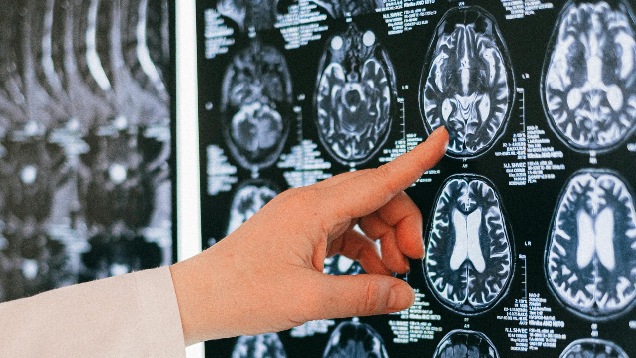 Top expert claims Alzheimer’s might not actually start in the brain