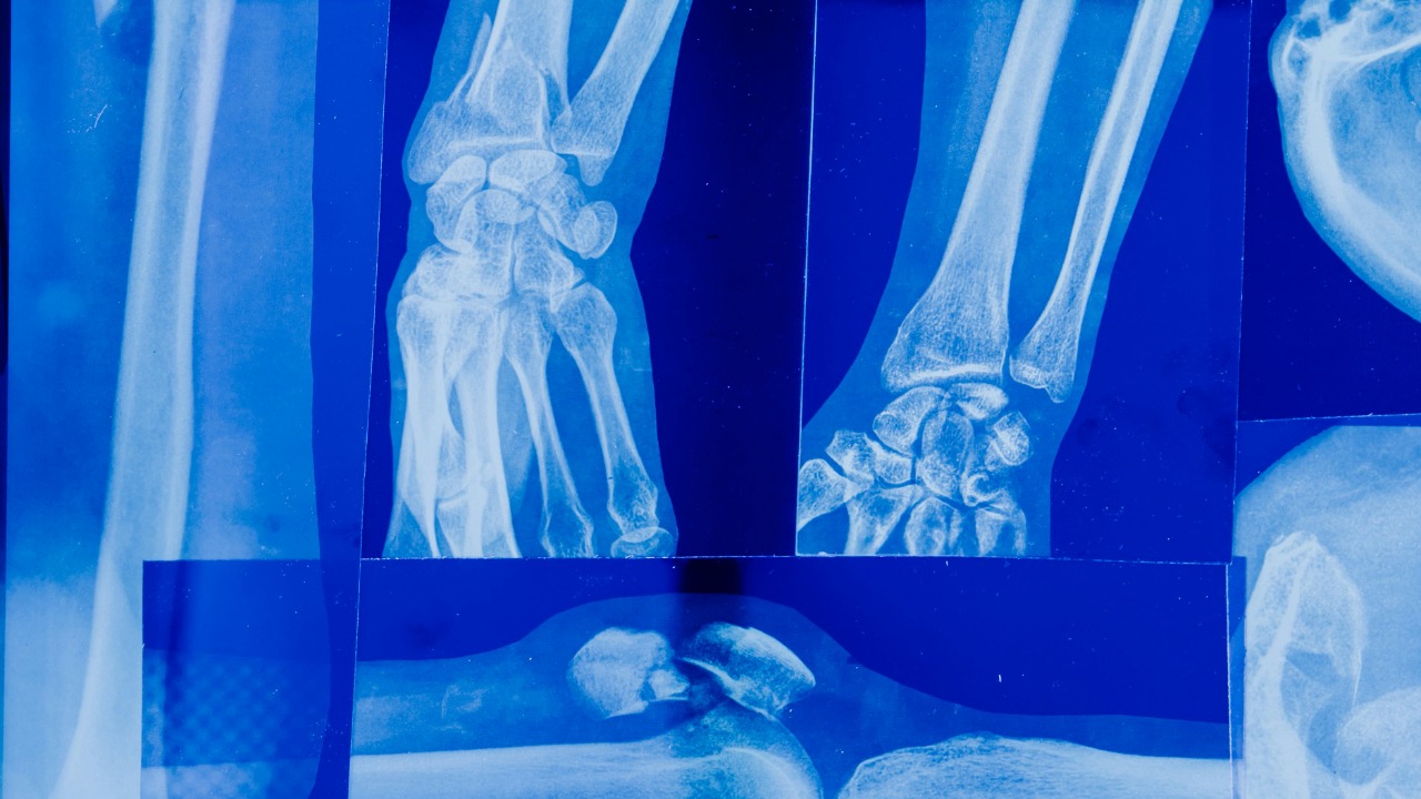 New breakthrough may let bones get workout benefits without moving