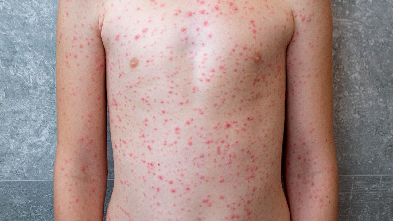 Is the US on the brink of losing its measles-free status?