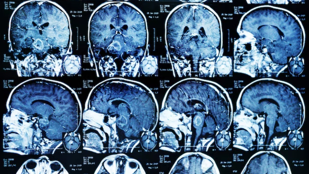 CO₂ ‘pulses’ flush toxins from Parkinson’s brains in stunning new study