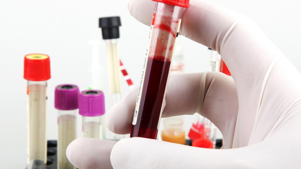 Simple blood test may spot Parkinson’s decades before symptoms