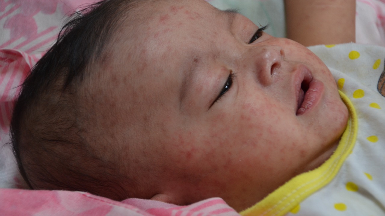 South Carolina measles spike exposes deadly risk of lower vaccination