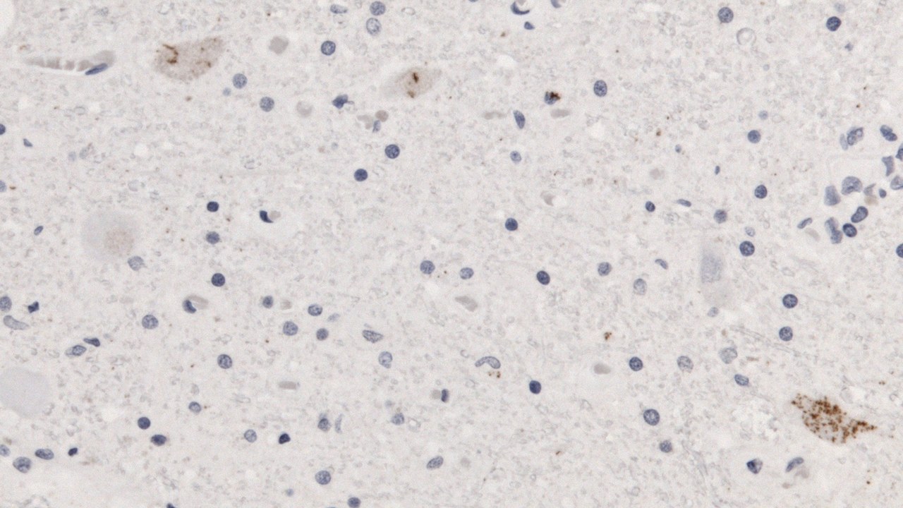 Amyotrophic lateral sclerosis — Image Credit: Jensflorian - CC BY-SA 4.0/Wiki Commons