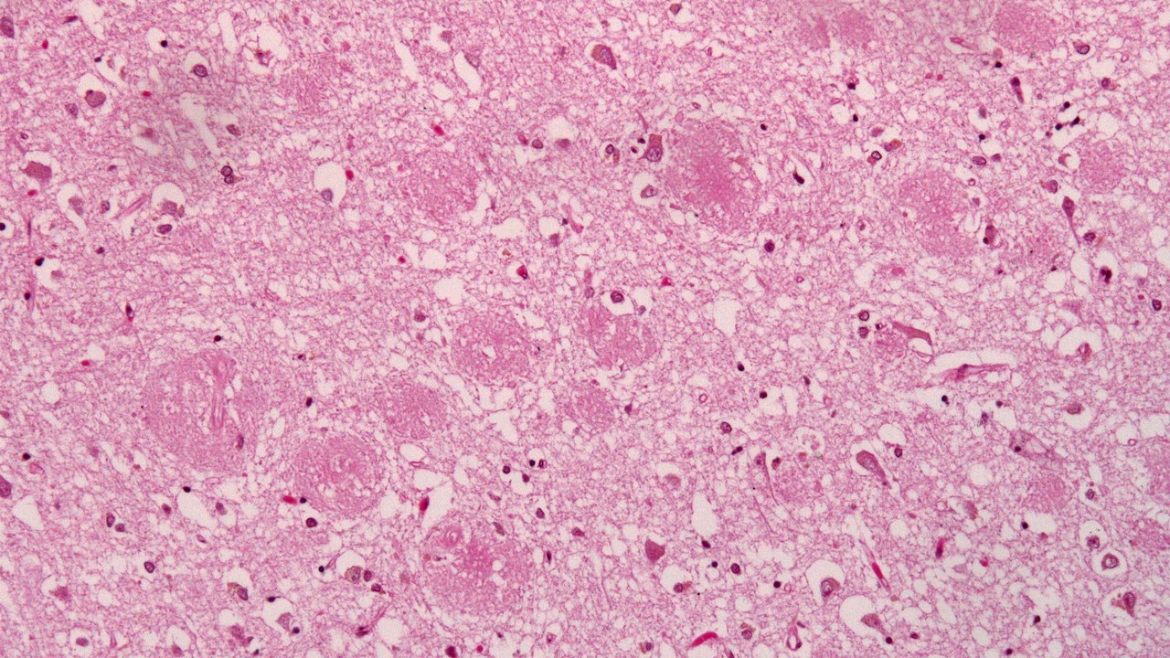 Alzheimer's disease — Image Credit: Jensflorian - CC BY-SA 3.0/Wiki Commons