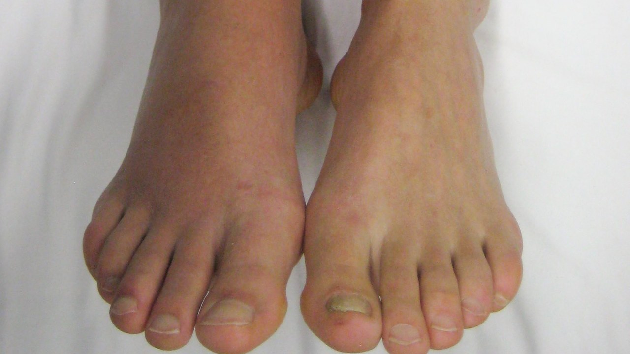 Venous thrombosis — Image Credit: James Heilman, MD - CC BY-SA 3.0/Wiki Commons